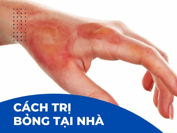 TOP 6 cách trị bỏng cấp tốc để hết rát nhanh lành vết thương